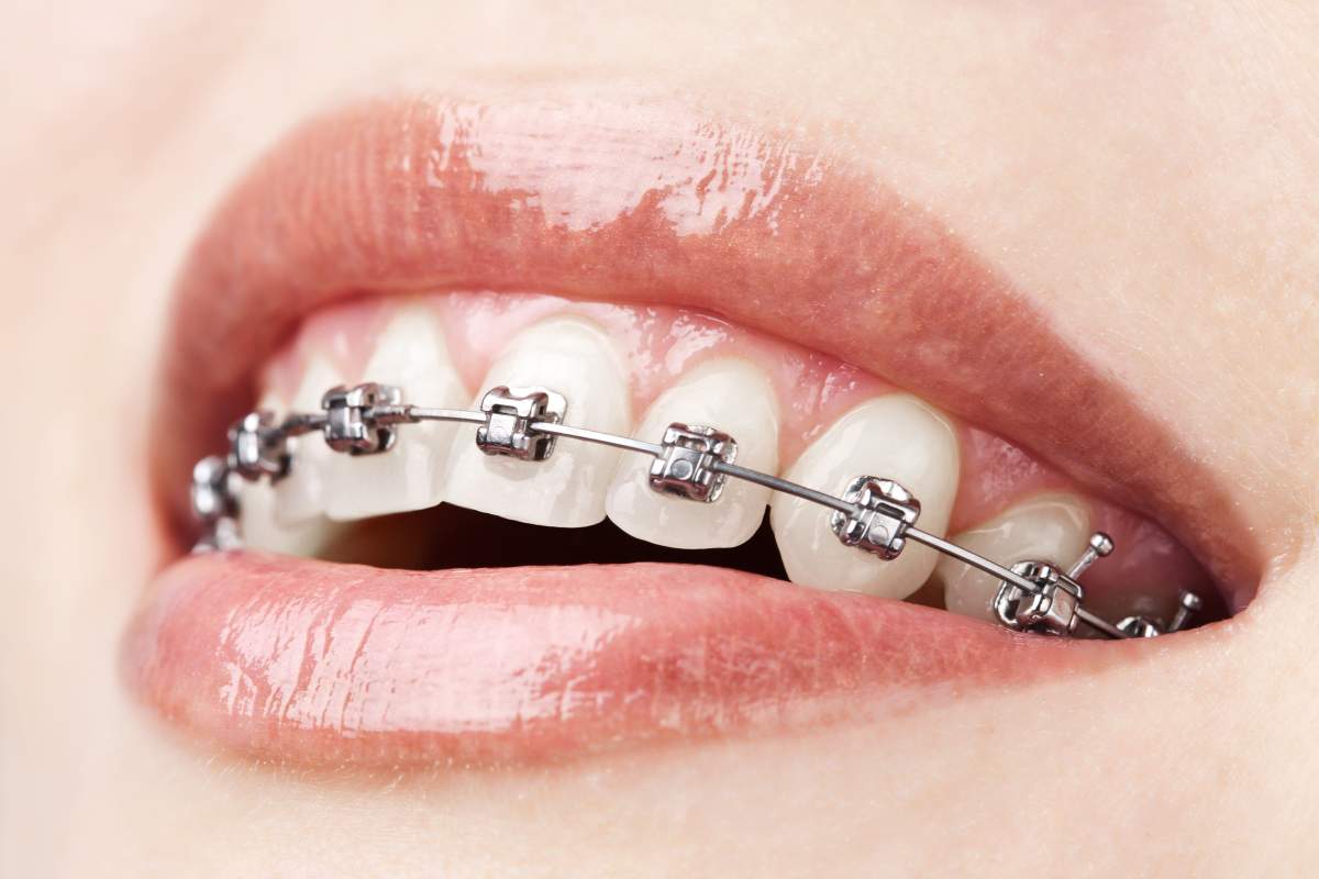 Orthodontics photo from Adobe Stock