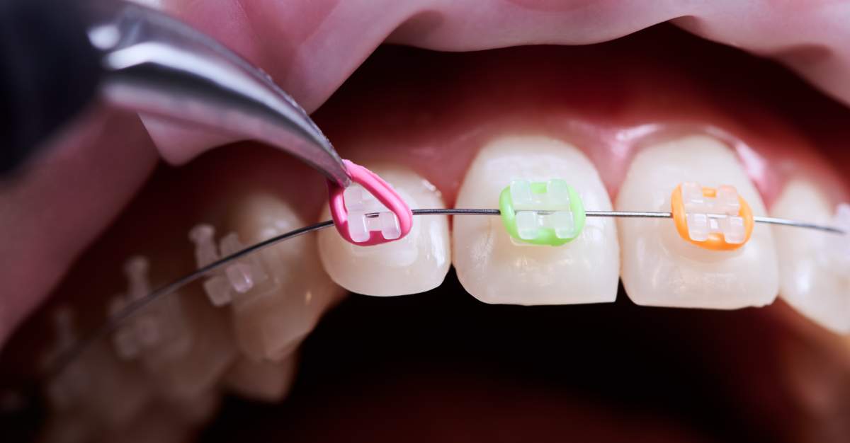 Orthodontics photo from Adobe Stock
